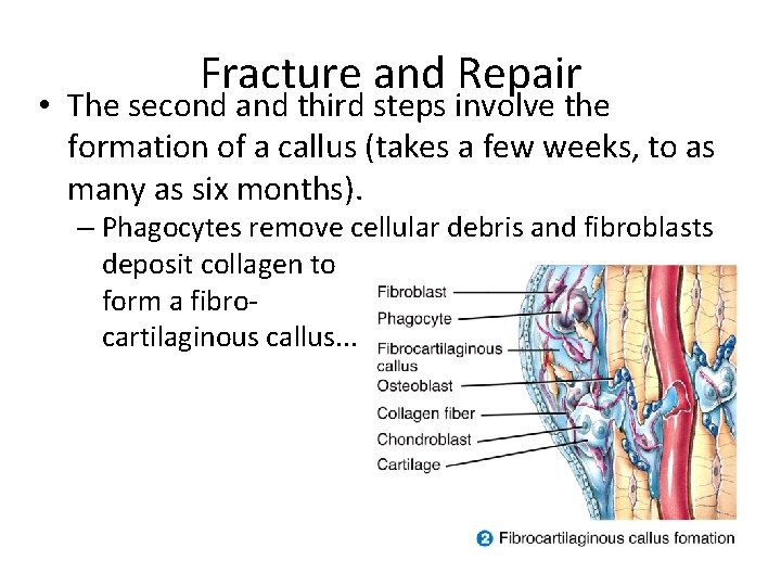 Fracture and Repair • The second and third steps involve the formation of a