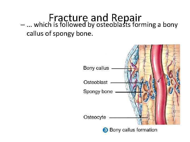 Fracture and Repair –. . . which is followed by osteoblasts forming a bony
