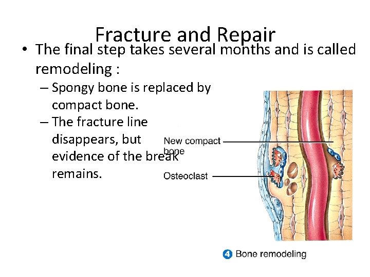 Fracture and Repair • The final step takes several months and is called remodeling