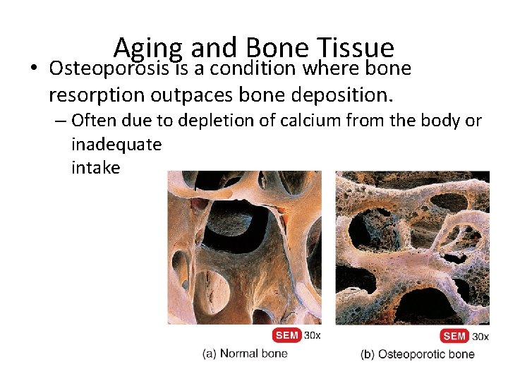 Aging and Bone Tissue • Osteoporosis is a condition where bone resorption outpaces bone