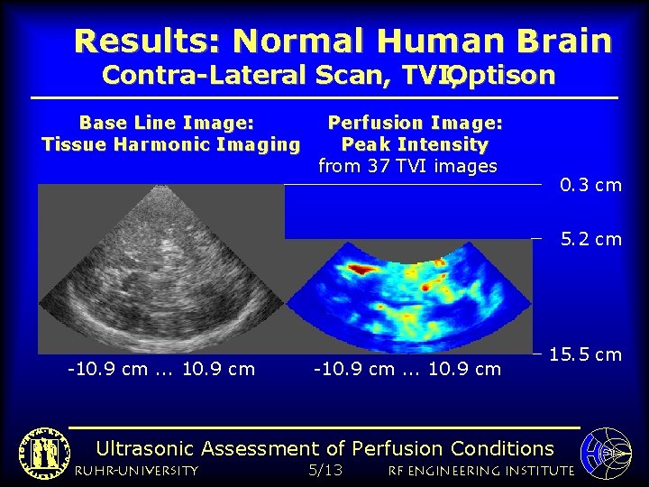 Results: Normal Human Brain Contra-Lateral Scan, TVI, Optison Base Line Image: Tissue Harmonic Imaging