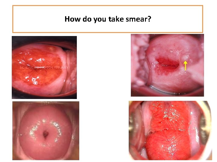 How do you take smear? 
