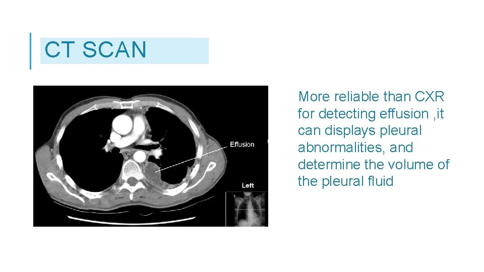 CT SCAN More reliable than CXR for detecting effusion , it can displays pleural