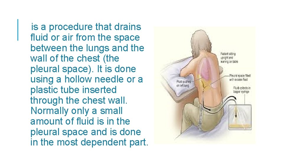 is a procedure that drains fluid or air from the space between the lungs