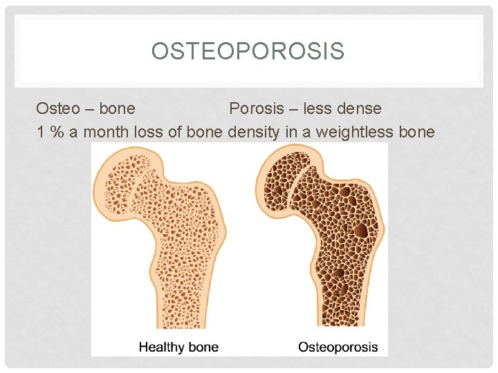 OSTEOPOROSIS Osteo – bone Porosis – less dense 1 % a month loss of