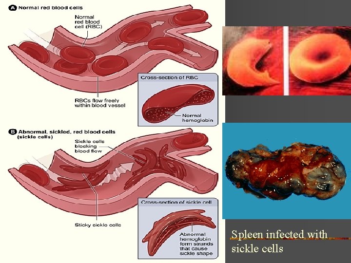 Spleen infected with sickle cells 