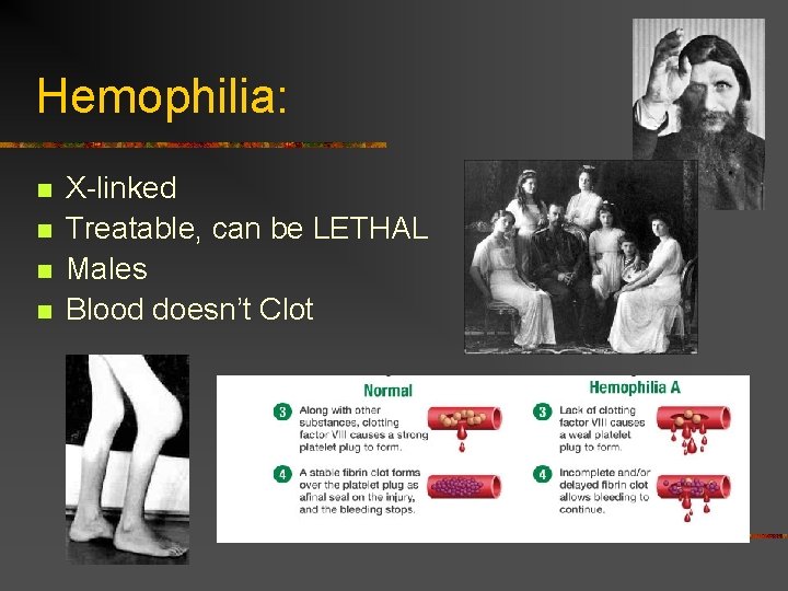 Hemophilia: n n X-linked Treatable, can be LETHAL Males Blood doesn’t Clot 