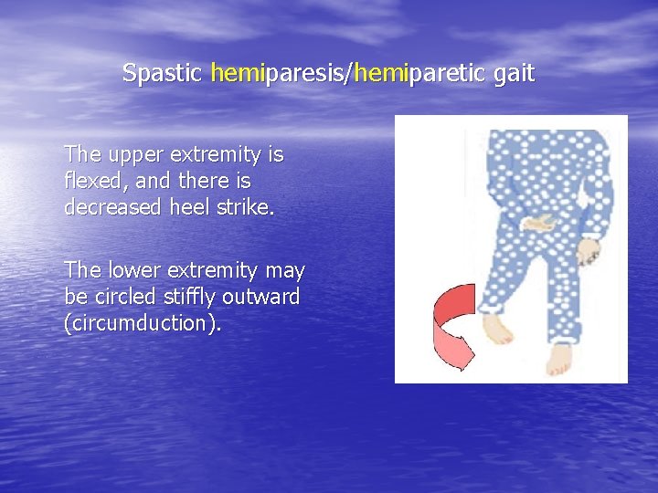 Spastic hemiparesis/hemiparetic gait The upper extremity is flexed, and there is decreased heel strike.