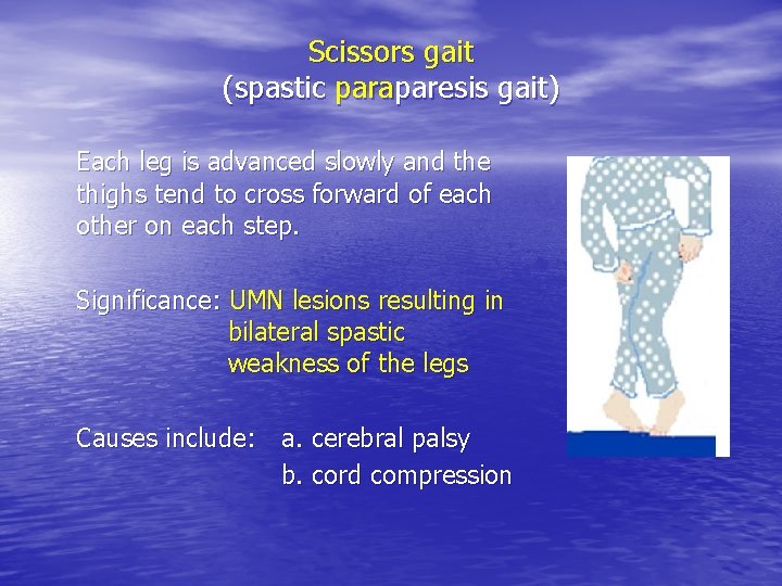 Scissors gait (spastic paraparesis gait) Each leg is advanced slowly and the thighs tend Scissors gait (spastic paraparesis gait) Each leg is advanced slowly and the thighs tend