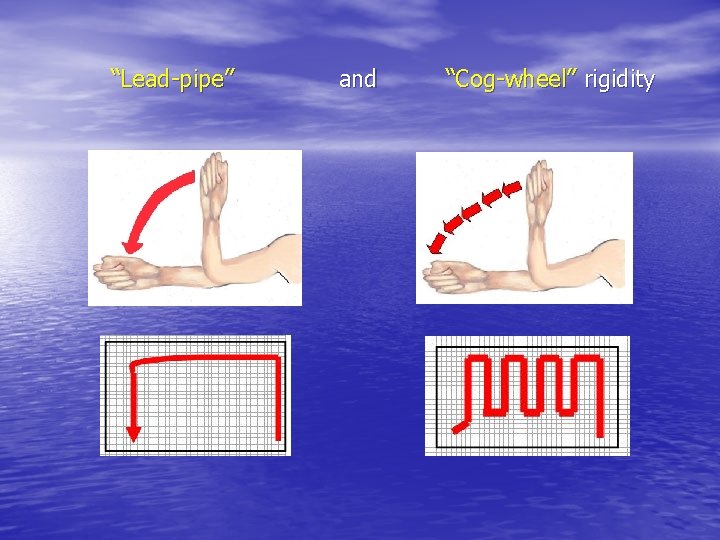 “Lead-pipe” and “Cog-wheel” rigidity 