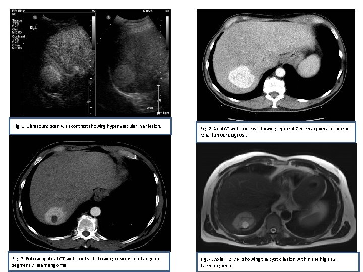 Fig. 1. Ultrasound scan with contrast showing hyper vascular liver lesion. Fig. 3. Follow