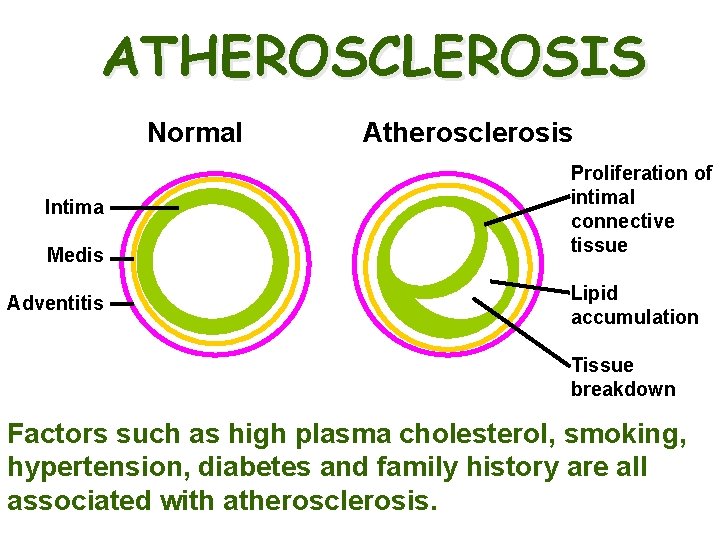 ATHEROSCLEROSIS Normal Intima Medis Adventitis Atherosclerosis Proliferation of intimal connective tissue Lipid accumulation Tissue