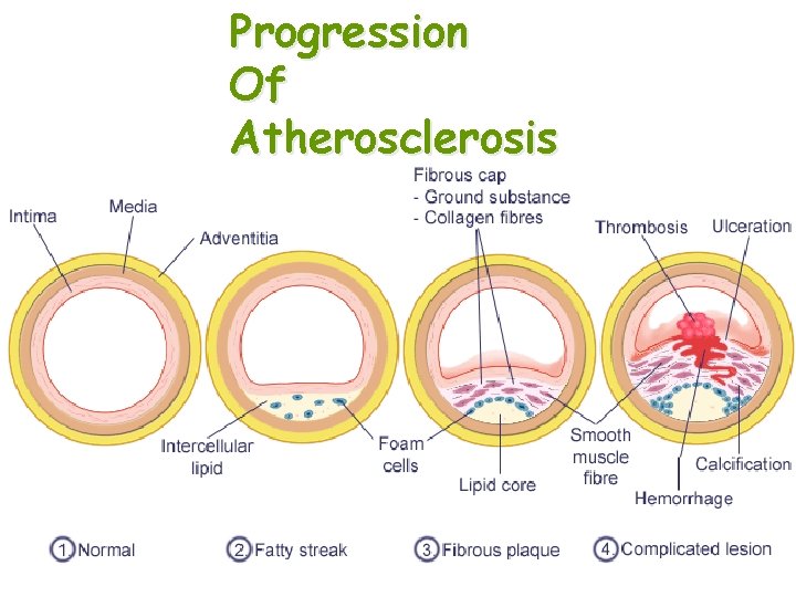 Progression Of Atherosclerosis 