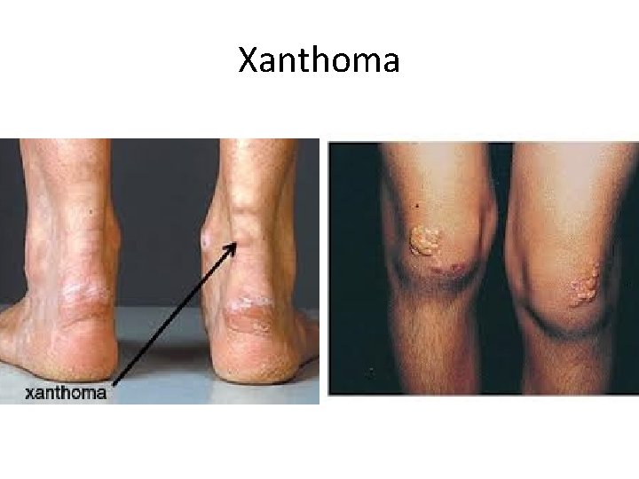 Xanthoma 