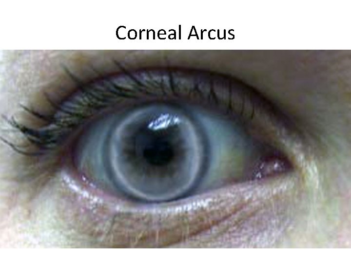 Corneal Arcus 