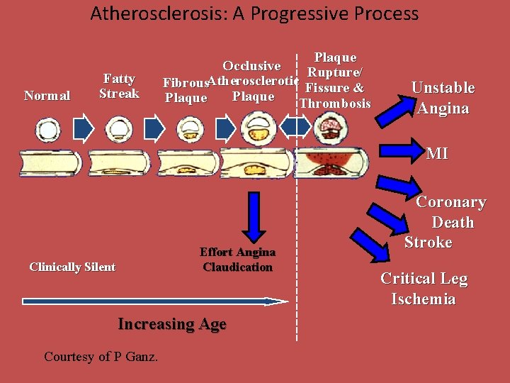 Atherosclerosis: A Progressive Process Normal Fatty Streak Plaque Occlusive Rupture/ Fibrous. Atherosclerotic Fissure &