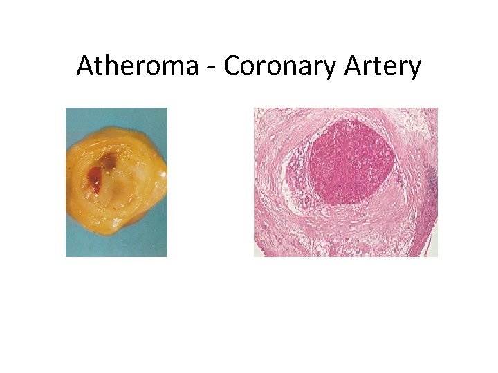 Atheroma - Coronary Artery 