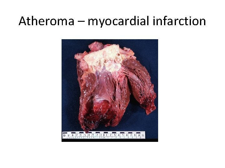 Atheroma – myocardial infarction 