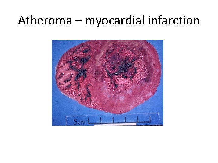 Atheroma – myocardial infarction 