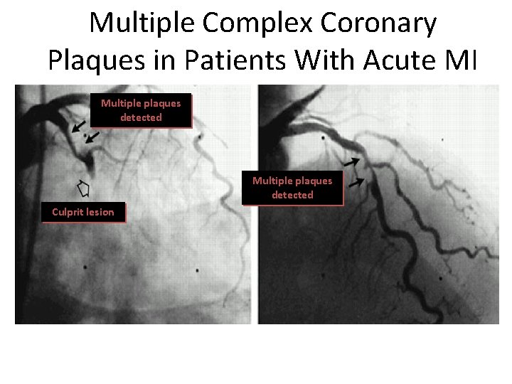 Multiple Complex Coronary Plaques in Patients With Acute MI Multiple plaques detected Culprit lesion