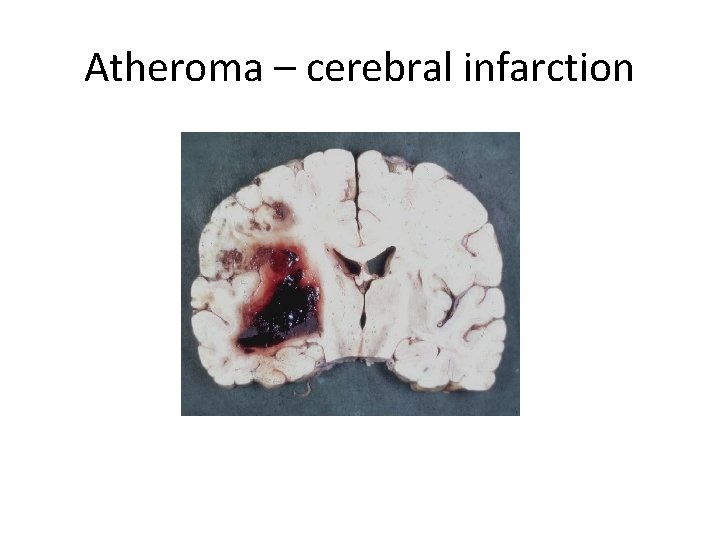 Atheroma – cerebral infarction 