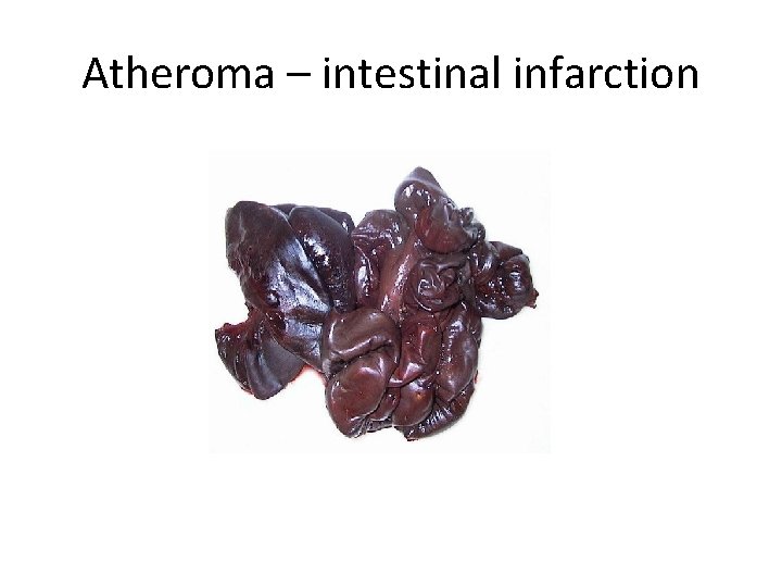 Atheroma – intestinal infarction 