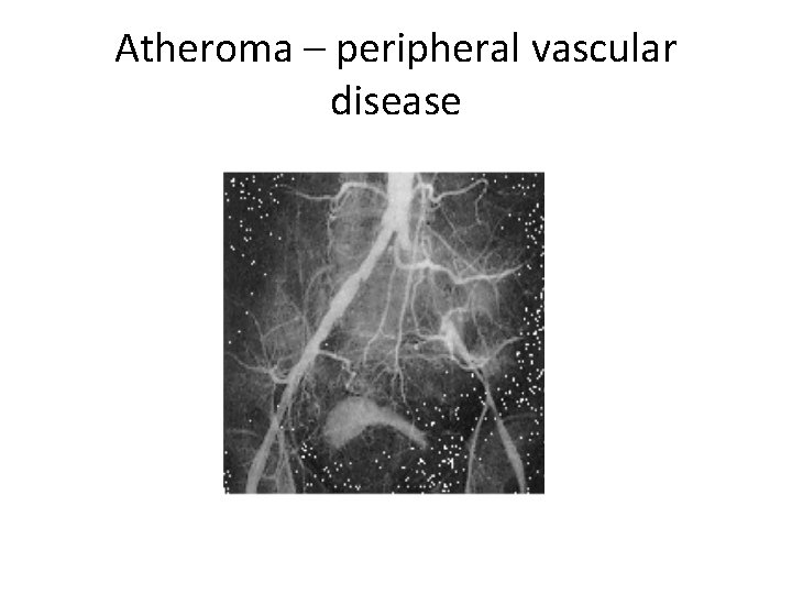 Atheroma – peripheral vascular disease 