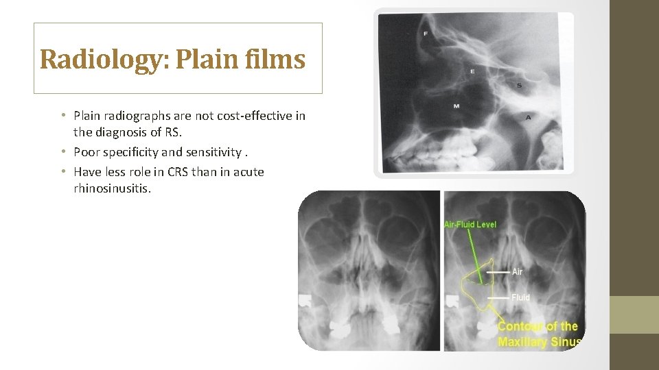 Radiology: Plain films • Plain radiographs are not cost-effective in the diagnosis of RS.