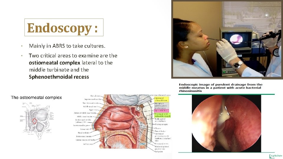 Endoscopy : • Mainly in ABRS to take cultures. • Two critical areas to