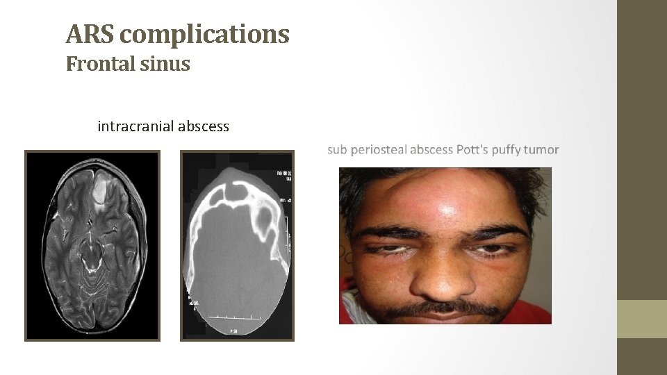 ARS complications Frontal sinus intracranial abscess 