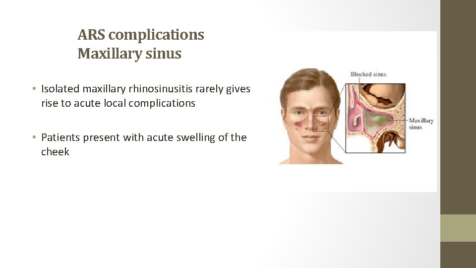 ARS complications Maxillary sinus • Isolated maxillary rhinosinusitis rarely gives rise to acute local