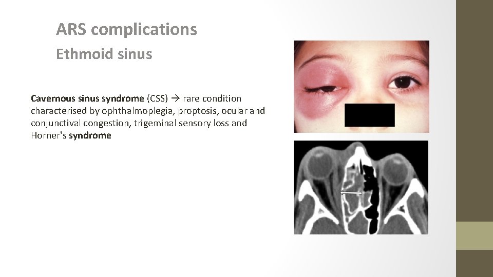 ARS complications Ethmoid sinus Cavernous sinus syndrome (CSS) rare condition characterised by ophthalmoplegia, proptosis,