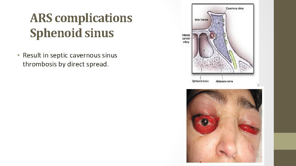 ARS complications Sphenoid sinus • Result in septic cavernous sinus thrombosis by direct spread.