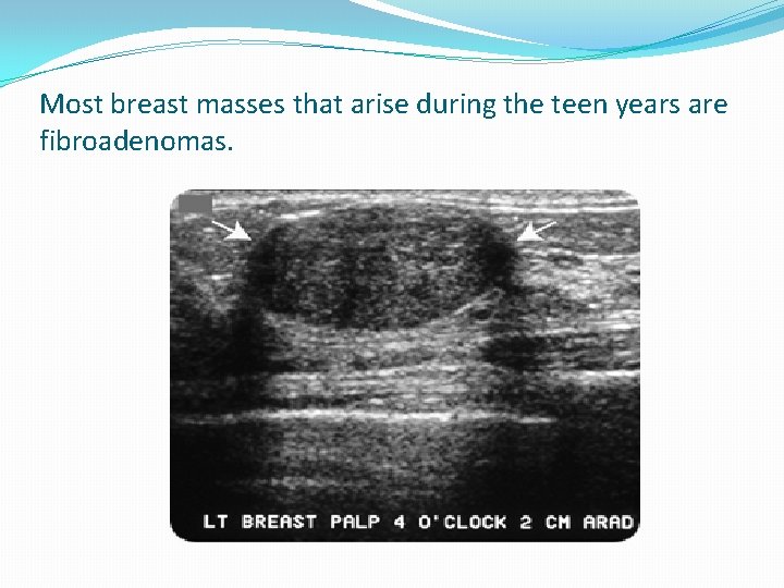 Most breast masses that arise during the teen years are fibroadenomas. 