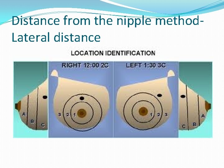 Distance from the nipple method. Lateral distance 