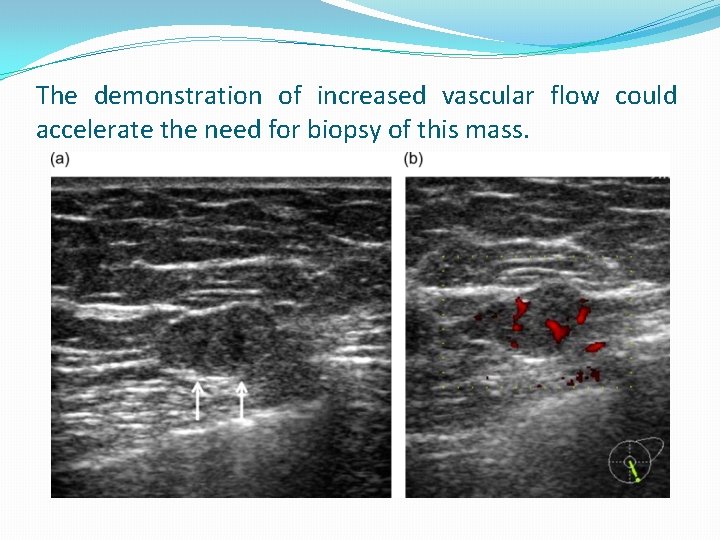 The demonstration of increased vascular flow could accelerate the need for biopsy of this