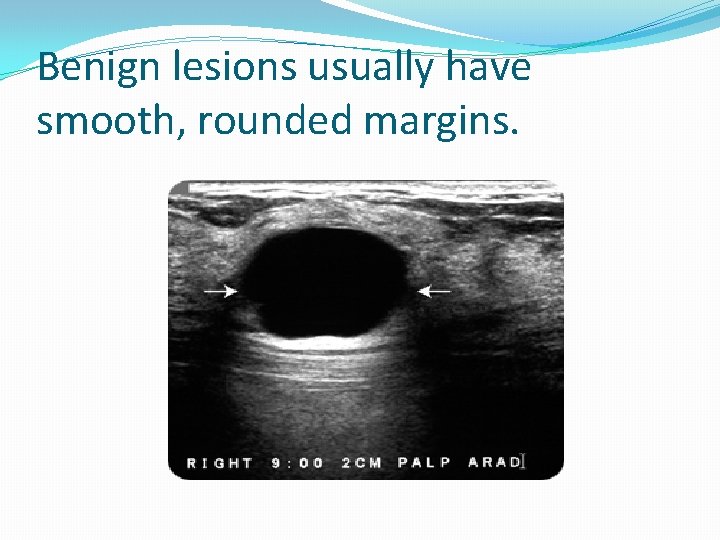 Benign lesions usually have smooth, rounded margins. 