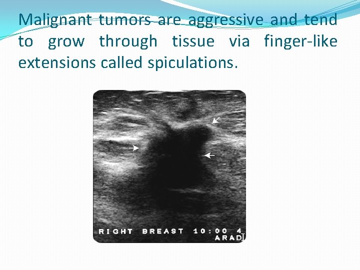 Malignant tumors are aggressive and tend to grow through tissue via finger-like extensions called