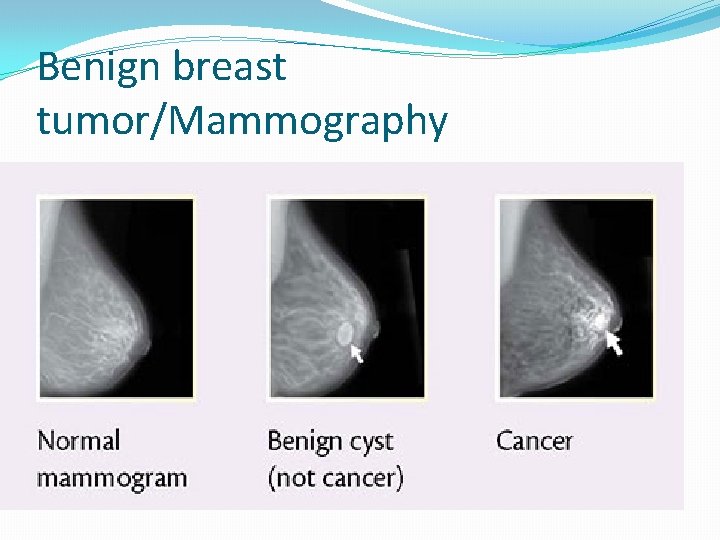 Benign breast tumor/Mammography 