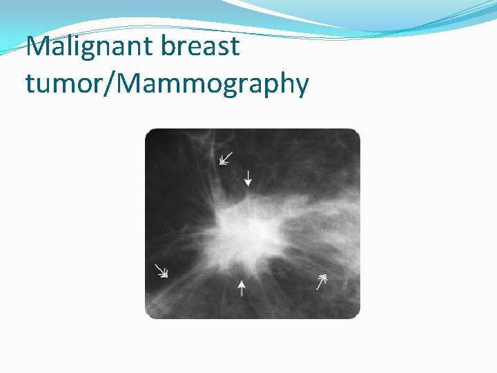 Malignant breast tumor/Mammography 