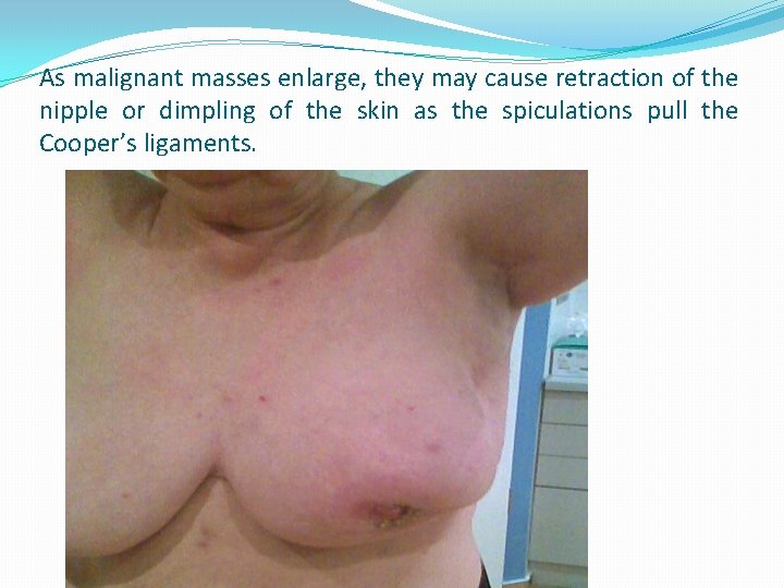 As malignant masses enlarge, they may cause retraction of the nipple or dimpling of