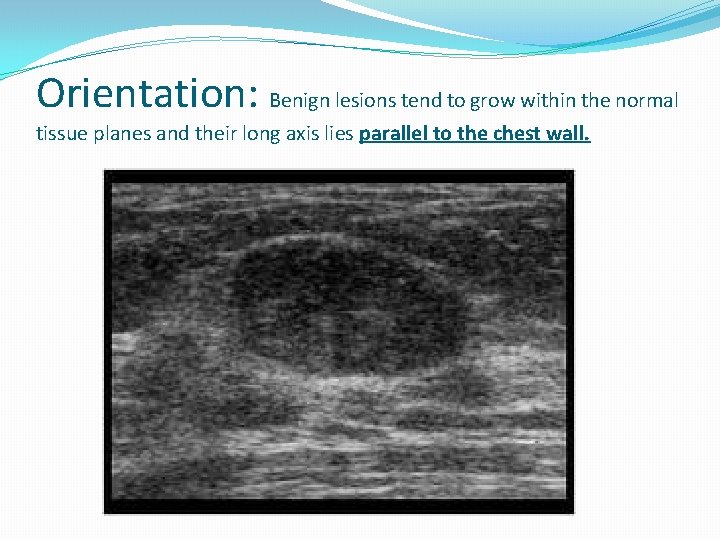 Orientation: Benign lesions tend to grow within the normal tissue planes and their long