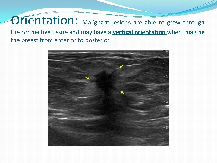 Orientation: Malignant lesions are able to grow through the connective tissue and may have