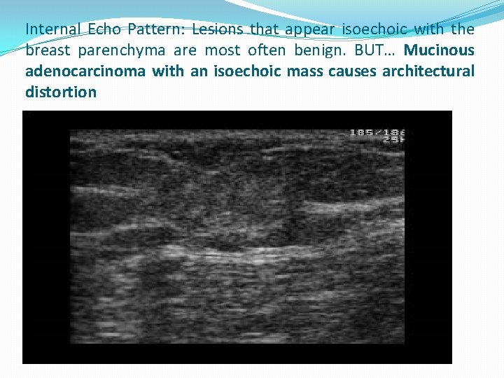 Internal Echo Pattern: Lesions that appear isoechoic with the breast parenchyma are most often