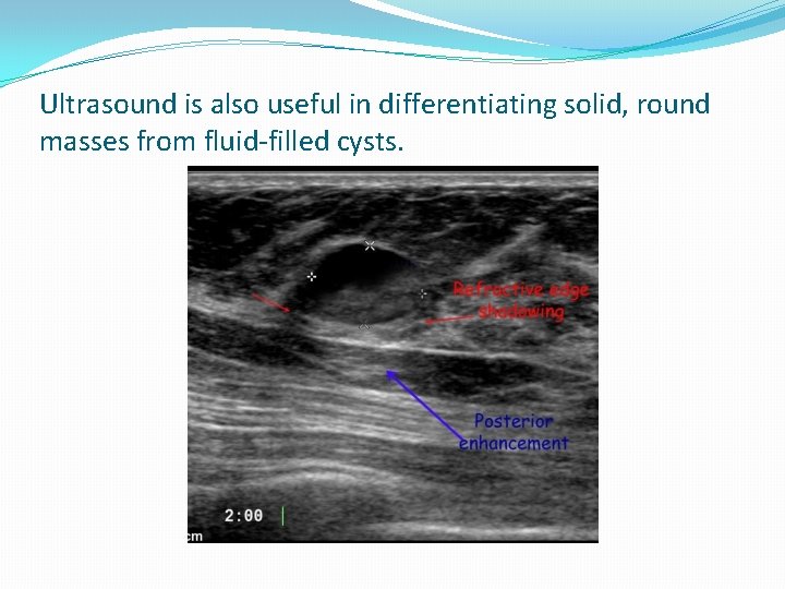 Ultrasound is also useful in differentiating solid, round masses from fluid-filled cysts. 