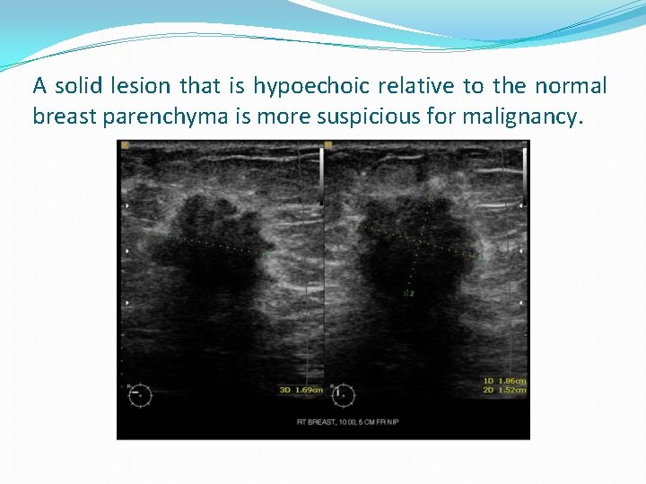 A solid lesion that is hypoechoic relative to the normal breast parenchyma is more