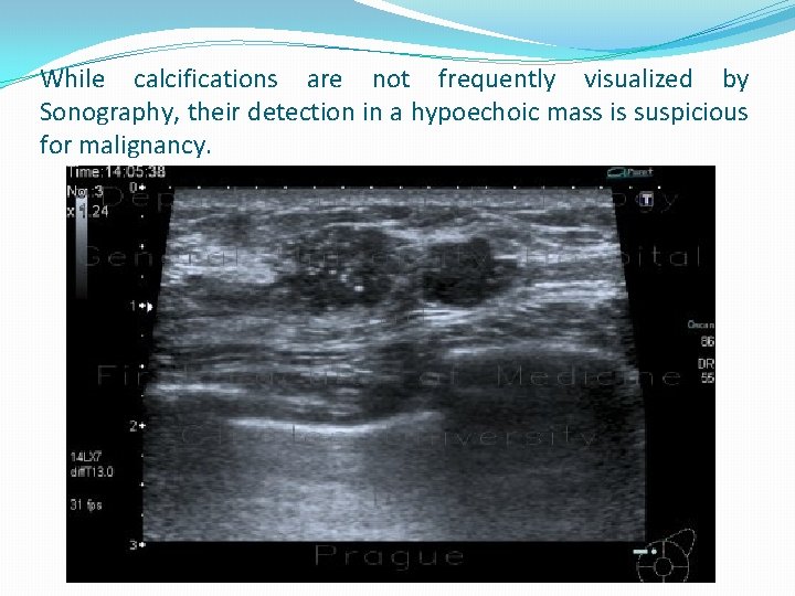 While calcifications are not frequently visualized by Sonography, their detection in a hypoechoic mass