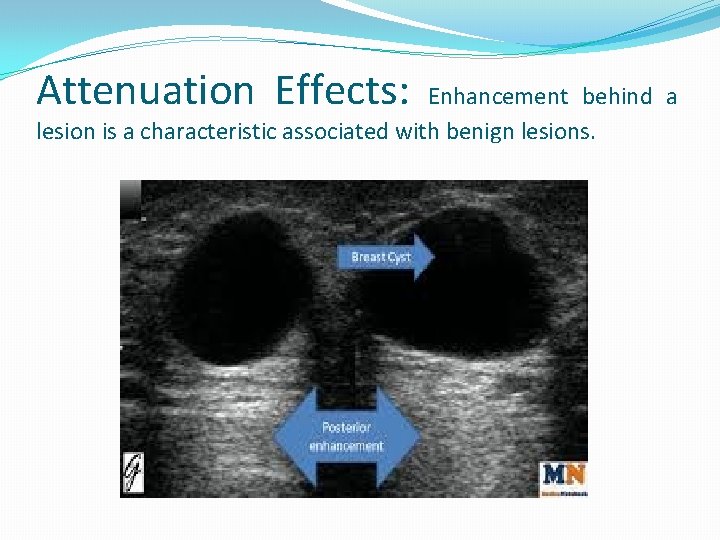 Attenuation Effects: Enhancement behind a lesion is a characteristic associated with benign lesions. 