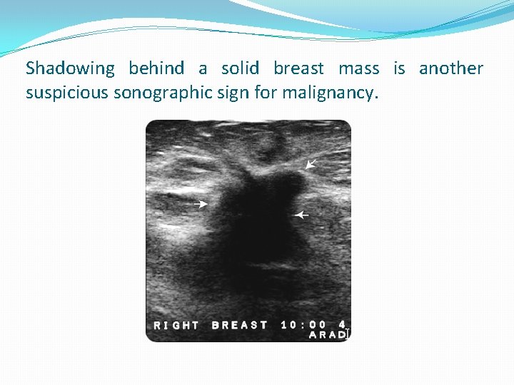Shadowing behind a solid breast mass is another suspicious sonographic sign for malignancy. 