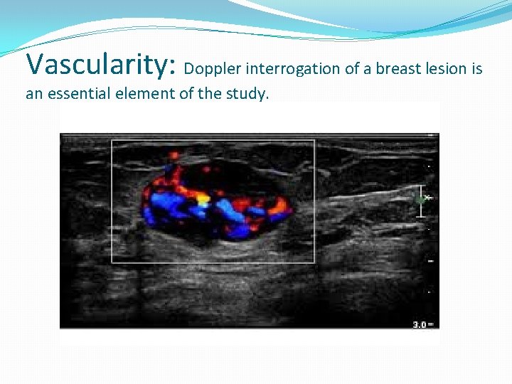 Vascularity: Doppler interrogation of a breast lesion is an essential element of the study.